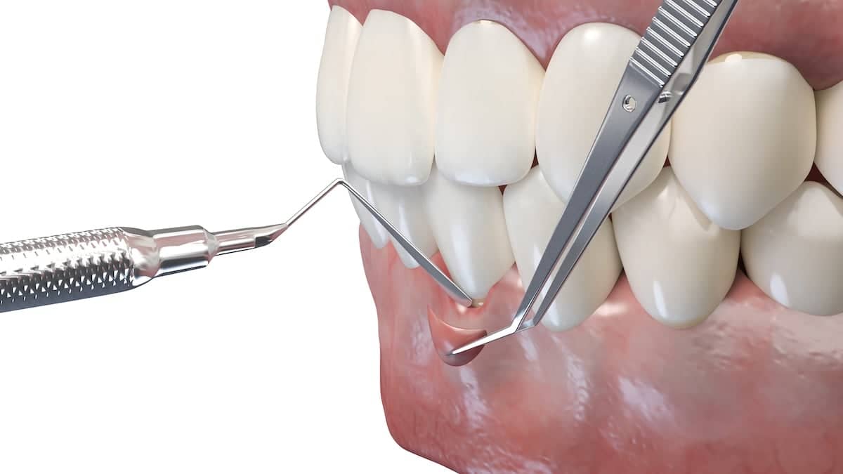 A close-up illustration of dental instruments performing a gum surgery procedure on human teeth