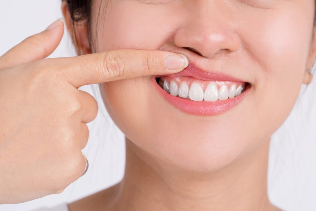 A person is holding up their upper lip with a finger, revealing a wide smile and white teeth. The background is plain and light-colored.