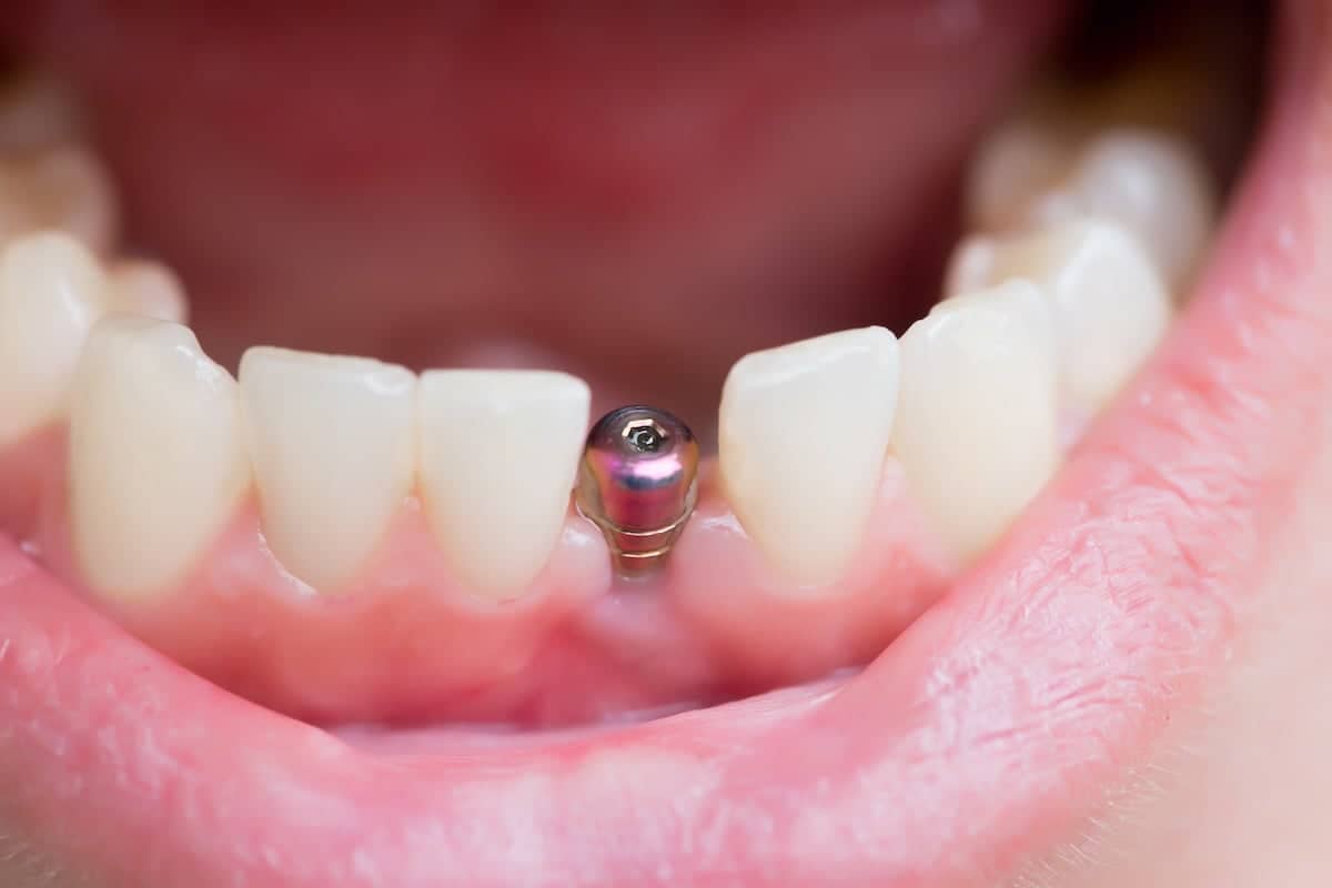 Close-up of an open mouth showing teeth and gums, with a dental implant visible where a tooth is missing in the lower front row.