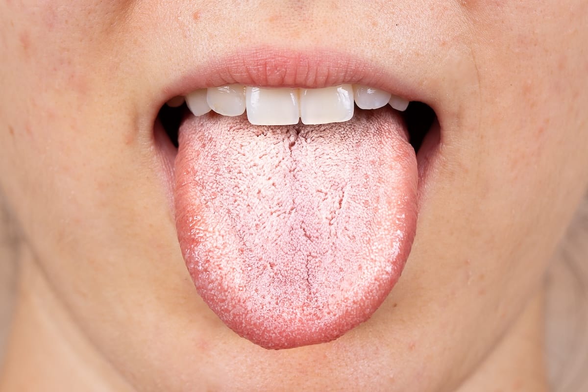 A close-up of a person's open mouth with their tongue sticking out, showing a white coating on the surface of the tongue.