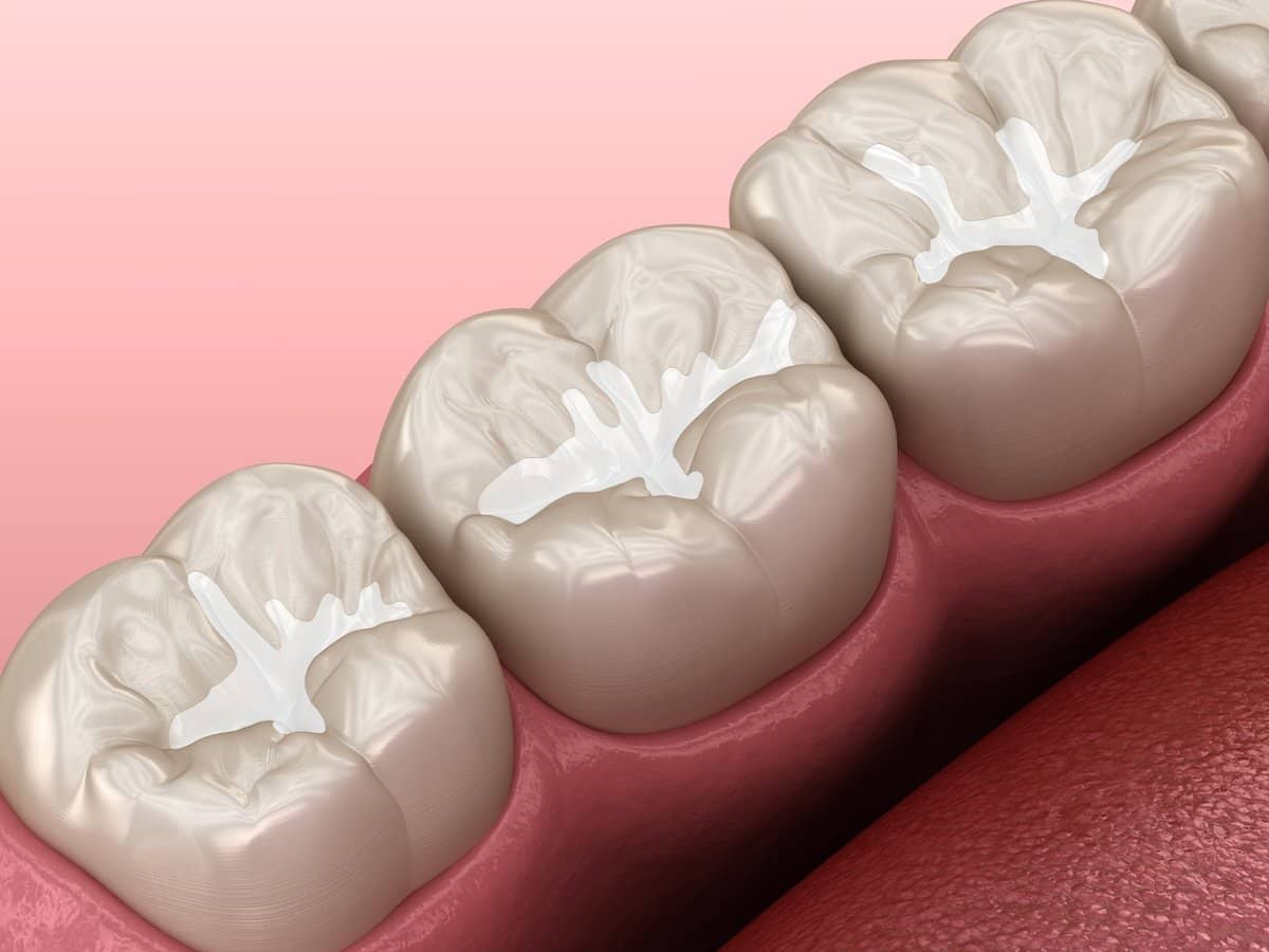 Illustration of three molar teeth with white dental sealant applied to the grooves on the chewing surfaces