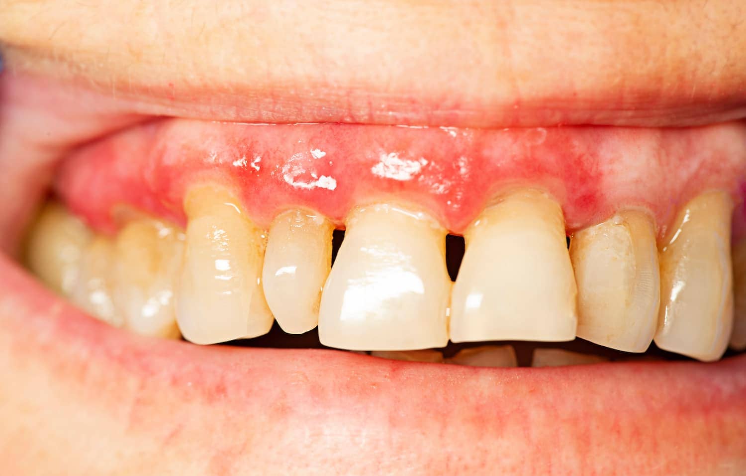 is periodontal disease contagious teeth