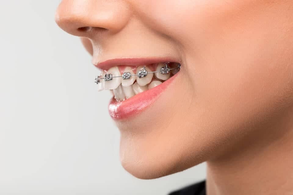 Close-up of a person smiling, showing their teeth with metal braces. The skin is smooth, and lips have a natural, light sheen. The background is plain and white, emphasizing the focus on the dental braces.